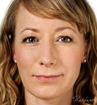 Restylane Treatments London
